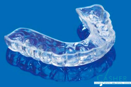 Contención dental para ortodoncia